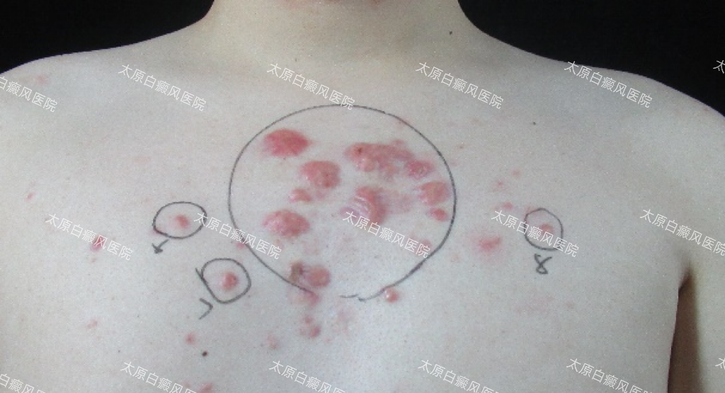 山西治疗疤痕疙瘩的医院